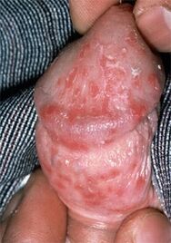 discharge from the penis due to corns